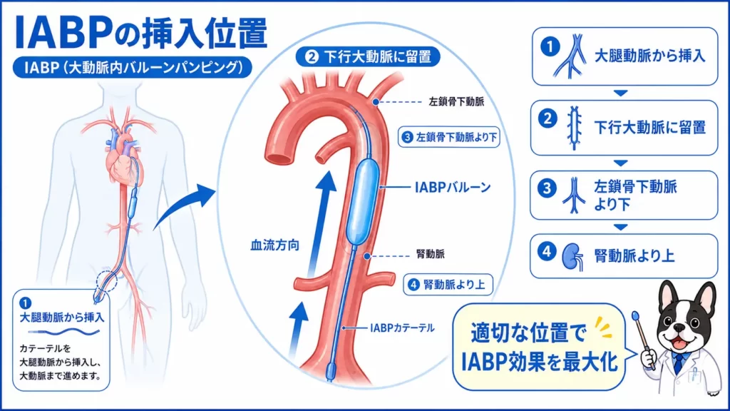 IABPの挿入位置を初心者向けに解説した医療図解。左鎖骨下動脈分岐部より末梢、腎動脈より中枢にバルーンを留置する位置を示したイラスト。