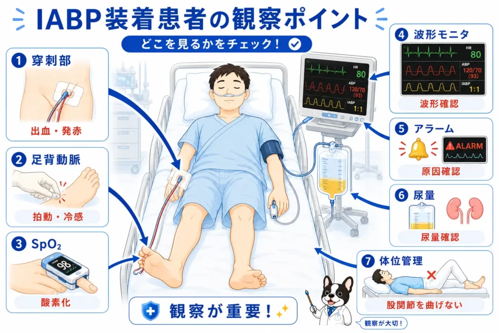 IABP装着患者の観察ポイントを初心者向けに解説した図解。波形モニタ、穿刺部、足背動脈、SpO2、尿量、アラーム、体位管理を示した医療イラスト。
