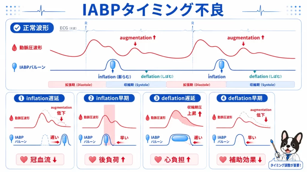 IABPのタイミング不良を4分割で比較した図解。inflation遅延、inflation早期、deflation遅延、deflation早期による波形変化を初心者向けに示したイラスト。